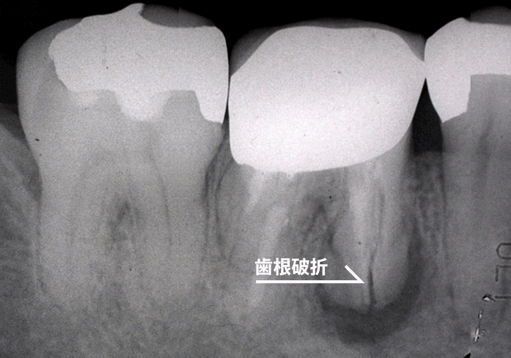 歯根破折のレントゲン写真