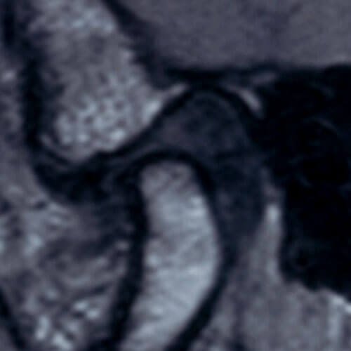 顎関節のMRI画像